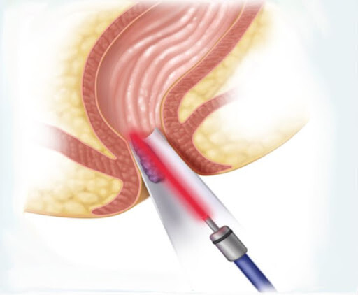 Hemoroidy Laserowa Ablacja Hemoroidów i Fałdów anodermy HLAHemoroidy Laserowa Ablacja Hemoroidów i Fałdów anodermy HLA