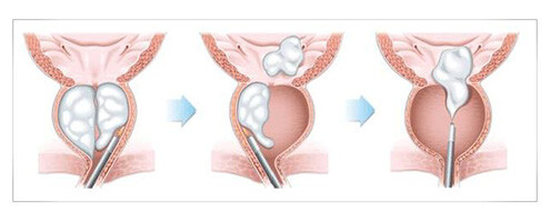 HoLEP Enukleacja prostaty Laserem Holmowym zielona góra chirurg urolog