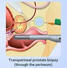 Biopsja prostaty zielona góra chirurg urolog