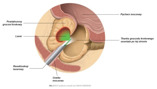 DVP Waporyzacja laserowa prostaty zielona góra chirurg urolog