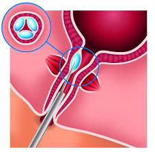 bulkamid zielona góra chirurg urolog