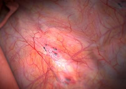 zabieg ELLA zielona góra chirurg urolog