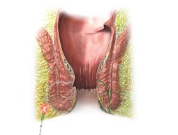 zabieg FILAC zielona góra chirurg urolog