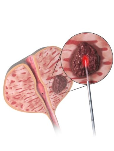 fla zabieg FLA zielona góra chirurg urolog