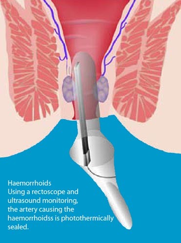 hemoroidy metoda Help zielona góra chirurg urolog