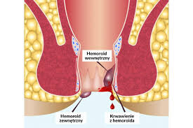 krwawienieodbyt krwawienie odbytu zielona góra chirurg urolog