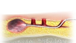 silac zabieg SILAC zielona góra chirurg urolog