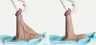 skrotoplatyka zielona góra chirurg urolog