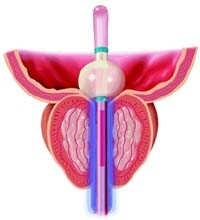 zabieg TUMT zielona góra chirurg urolog