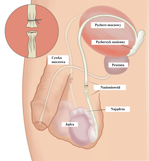 wazekotomia zielona góa chirurg urolog