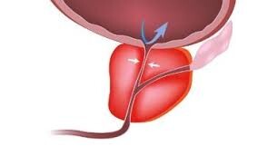 zapalenie prostaty zielona góra chirurg urolog