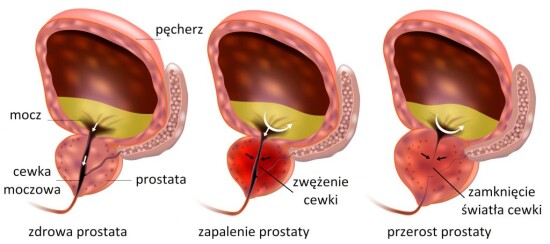 zatrzymanie moczu zielona góra chirurg urolog