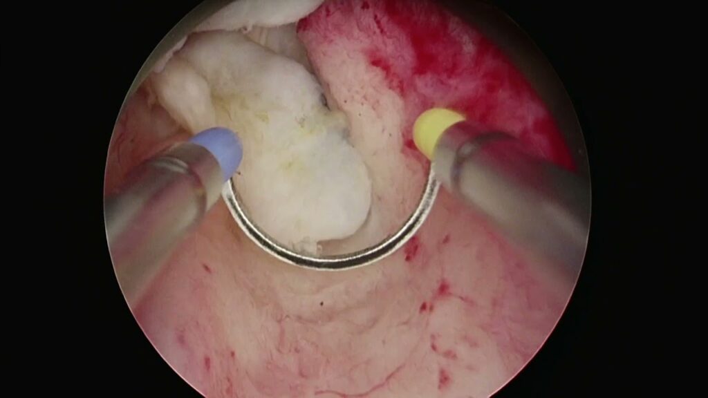 BipoLEP bipolarna enukleacja prostaty