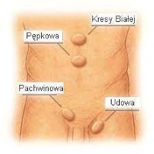 leczenie przepukliny