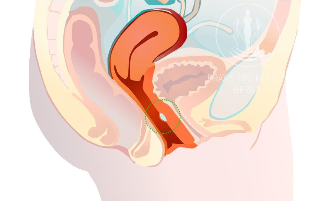 punkt-g stymulowanie punkty G kwasem hialuronowym